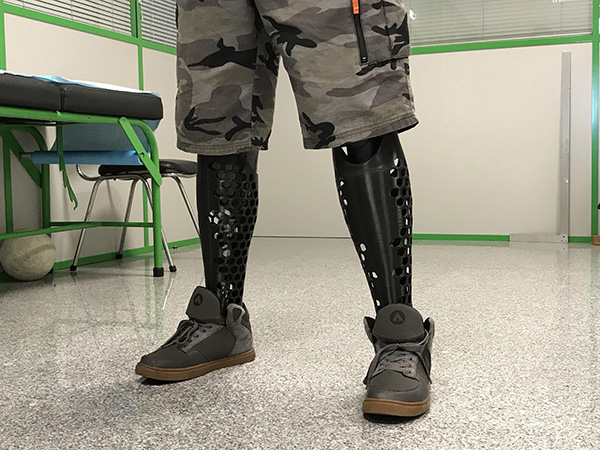 3D printed prosthetic covers